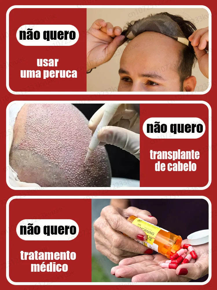 Óleo Especial Para Crescimento Capilar Eficaz no Tratamento de Calvície e Queda de Cabelo